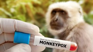 vaiolo delle scimmie mpox
