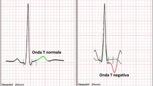 elettrocardiogramma anomalie Onda T normale Onda T negativa