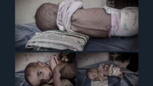 Gaza - luglio 2025 - i bambini stanno morendo di fame